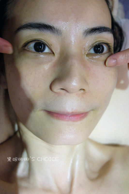 拓顏後左眼黑眼圈