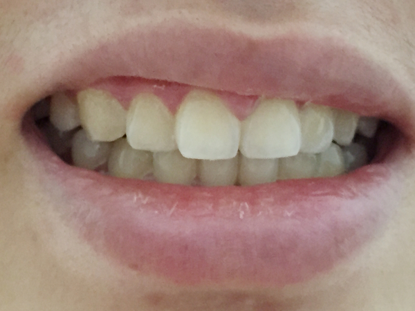 蓓樂膚PURIFY：［口腔保養］讓植淨的牙膏與漱口水，照顧好你的牙周健康，活性氧抗菌讓植牙保養也免煩惱!