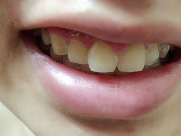 蓓樂膚PURIFY：［口腔保養］讓植淨的牙膏與漱口水，照顧好你的牙周健康，活性氧抗菌讓植牙保養也免煩惱!