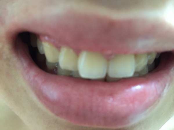 蓓樂膚PURIFY：［口腔保養］讓植淨的牙膏與漱口水，照顧好你的牙周健康，活性氧抗菌讓植牙保養也免煩惱!