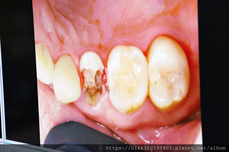 20180905牙齒清理 (1).JPG