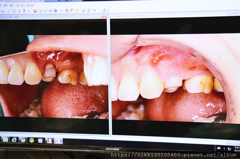 20180912牙冠手術 (26).JPG